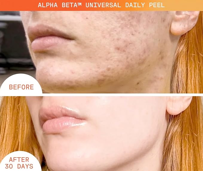 Dr. Dennis Gross Alpha Beta Universal Daily Peel: for Uneven Tone or Texture and Fine Lines or Enlarged Pores, (5 Treatments)