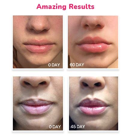 LifeCell Lip Plumping Treatment – Glossy Balm with MaxiLip Peptides for Fuller, Smoother Lips – Hydrating, Non-Irritating, Fragrance-Free Lip Care for All Skin Types