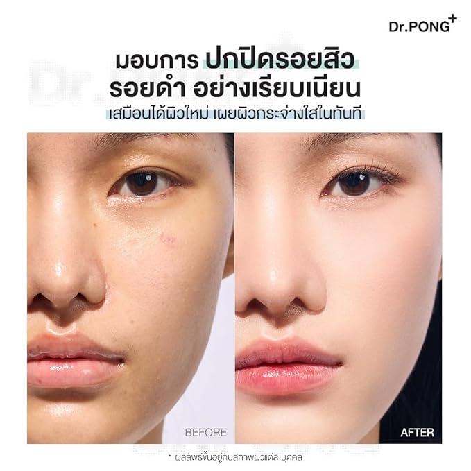 Dr.PONG ACNE ACE Longwear Cushion (Honey, 15) 15g