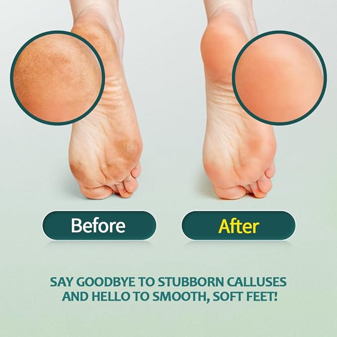 Gorgellux callus remover gel, callus
