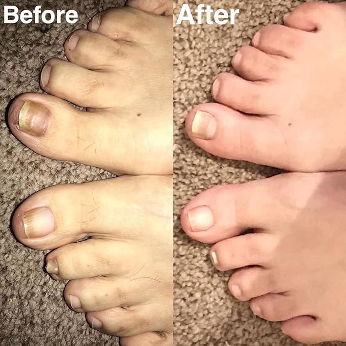 Probelle Natural Fungal Nail Oil,