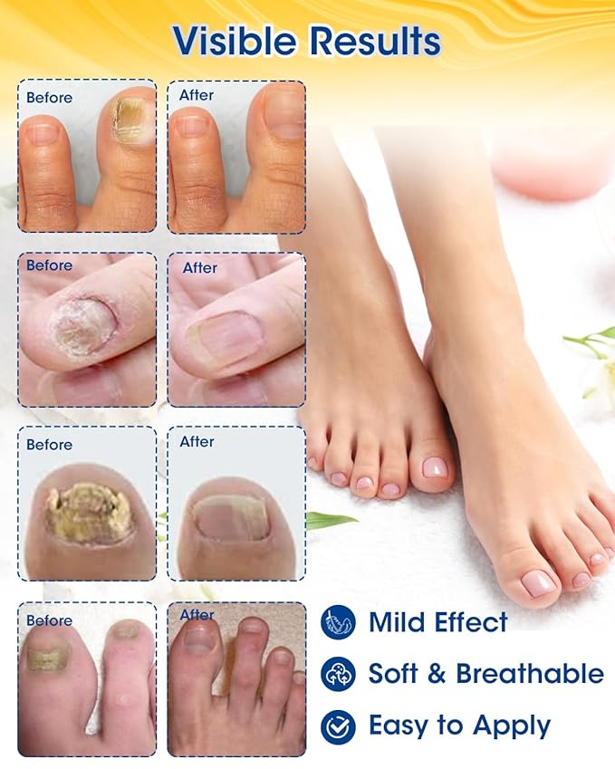 Nail Repair Patches Extra Strength,