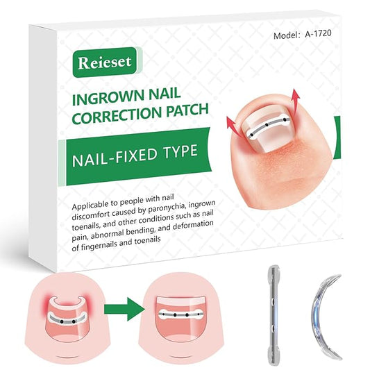 Titanium alloy ingrown toenail treatment-