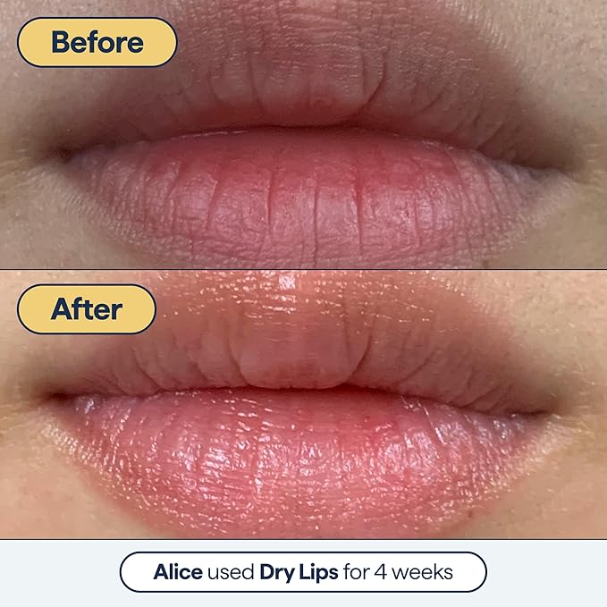 Remedy for Dry Lips - Hydrating